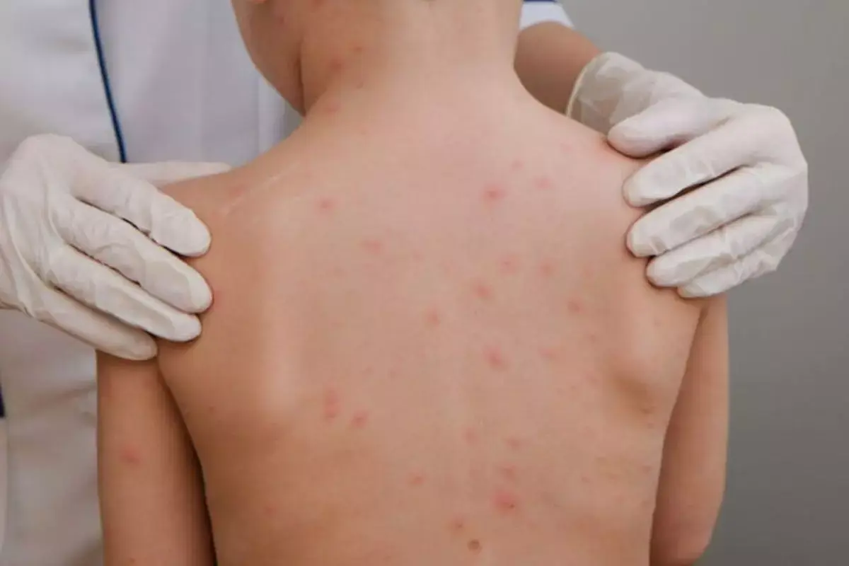 Criança de 4 anos é diagnosticada com meningite bacteriana em município da região
