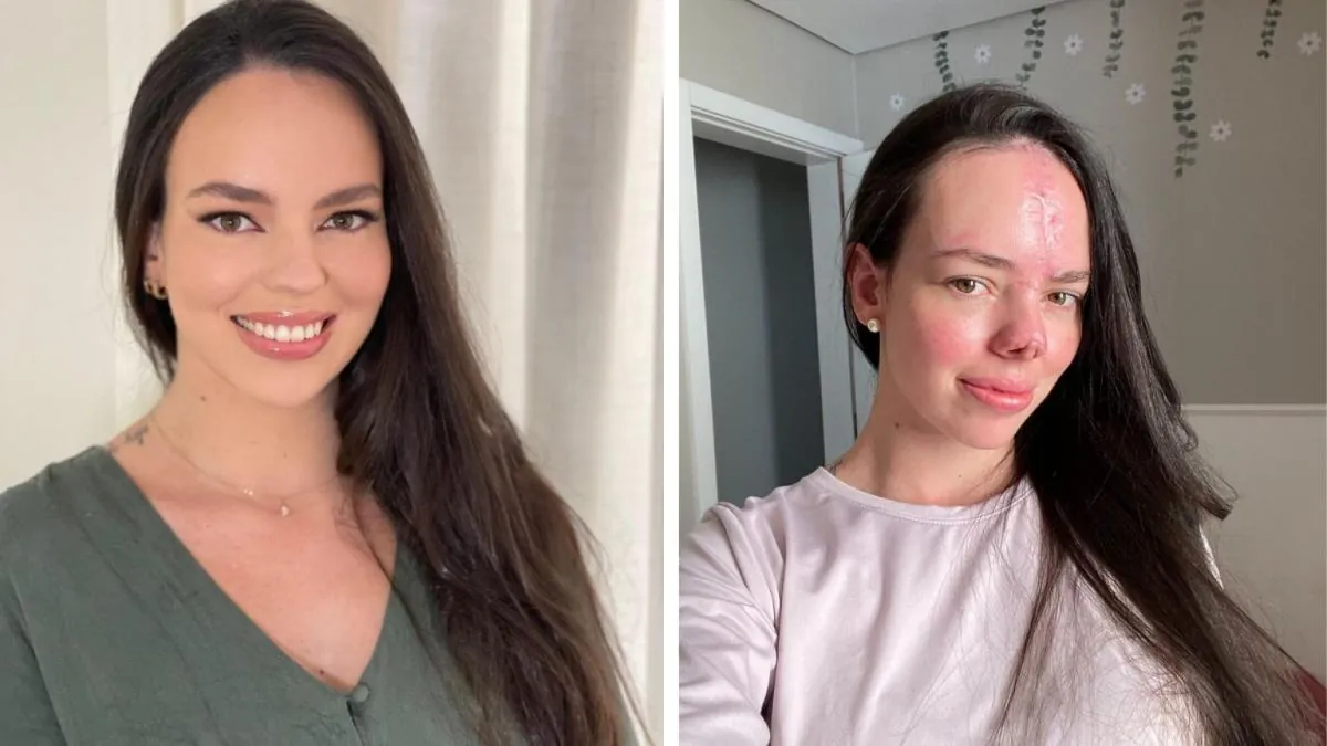Luzernense passa por reconstrução facial após acidente e usa trauma para encorajar outras pessoas
